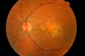 Example of Dry AMD
