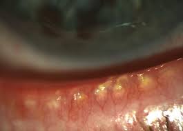 IPL (INTENSE PULSED LIGHT) AND MEIBOMIAN GLAND EXPRESSION | Thompson  Optometrists